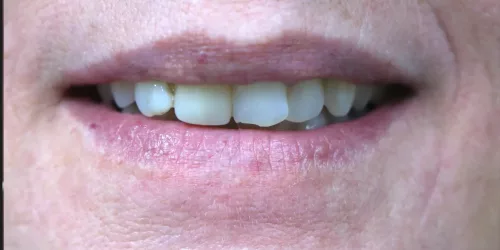 after-cosmatic-dental