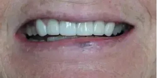 after-smile-transformation