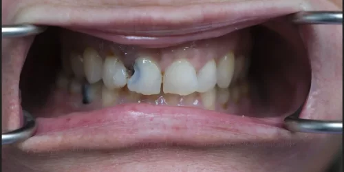 before-cosmatic-dental